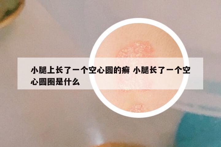 小腿上长了一个空心圆的癣 小腿长了一个空心圆圈是什么