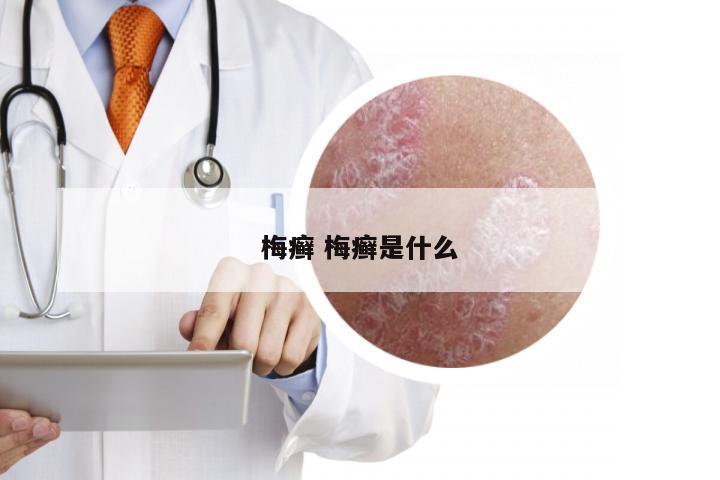 梅癣 梅癣是什么