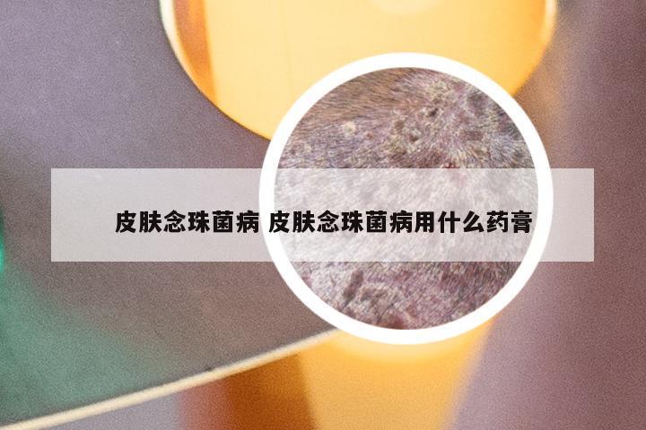 皮肤念珠菌病 皮肤念珠菌病用什么药膏