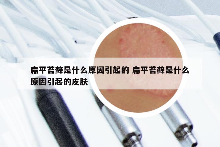 扁平苔藓是什么原因引起的 扁平苔藓是什么原因引起的皮肤