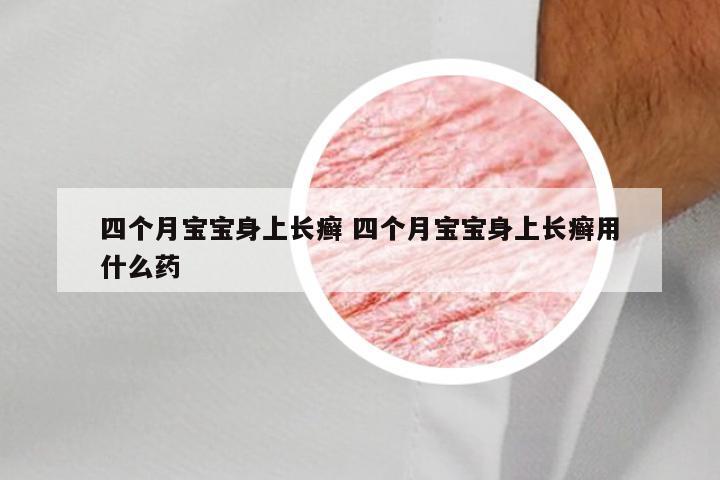 四个月宝宝身上长癣 四个月宝宝身上长癣用什么药