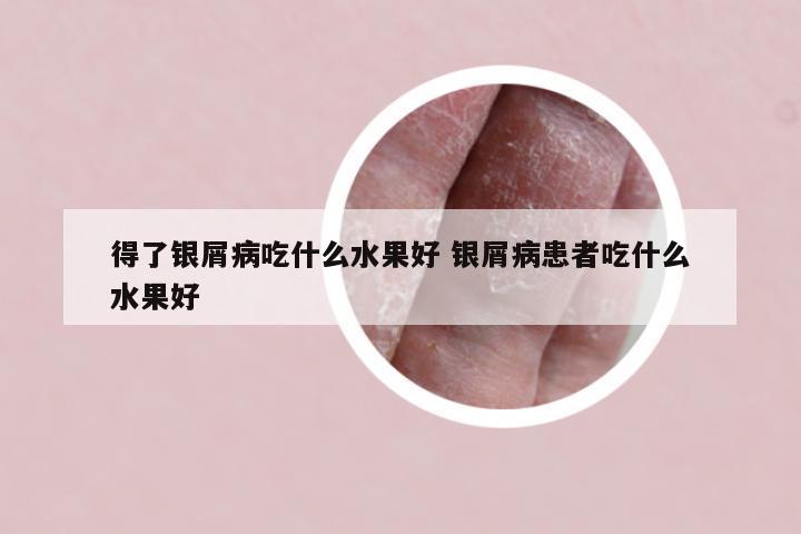 得了银屑病吃什么水果好 银屑病患者吃什么水果好