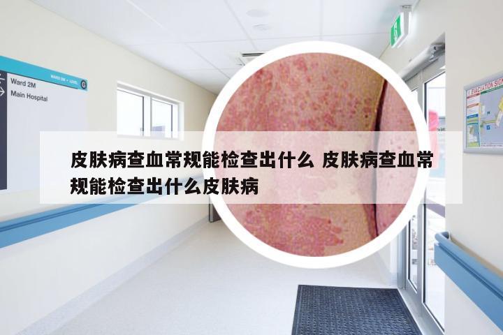 皮肤病查血常规能检查出什么 皮肤病查血常规能检查出什么皮肤病