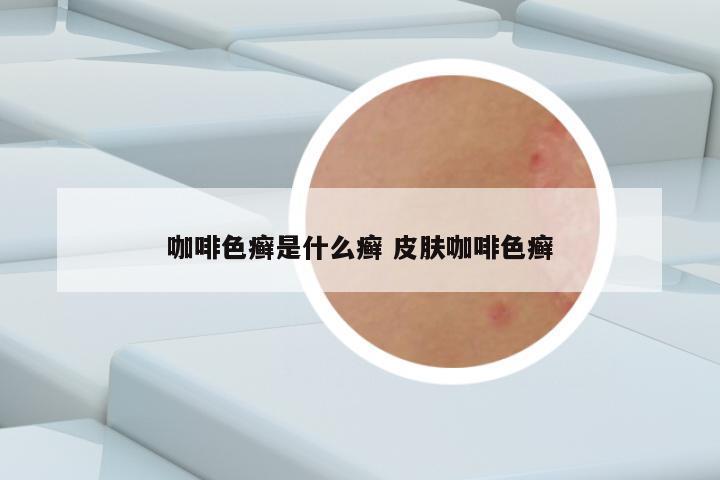 咖啡色癣是什么癣 皮肤咖啡色癣