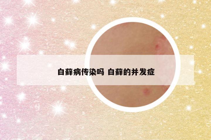白藓病传染吗 白藓的并发症