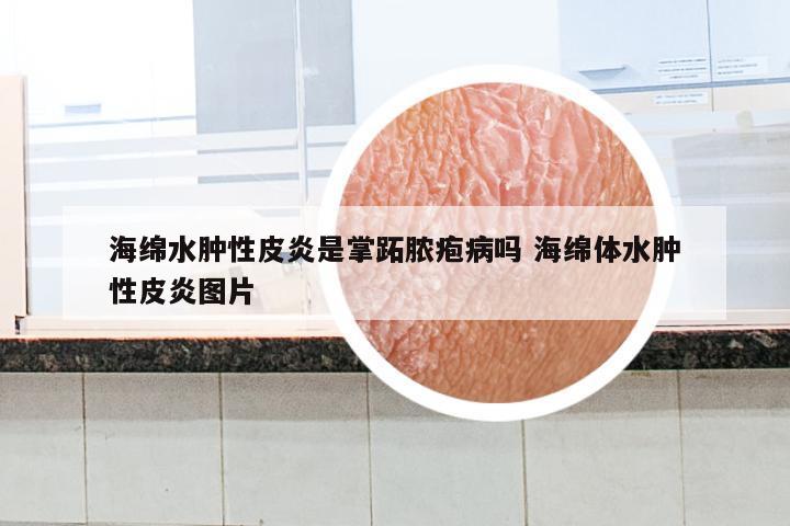 海绵水肿性皮炎是掌跖脓疱病吗 海绵体水肿性皮炎图片
