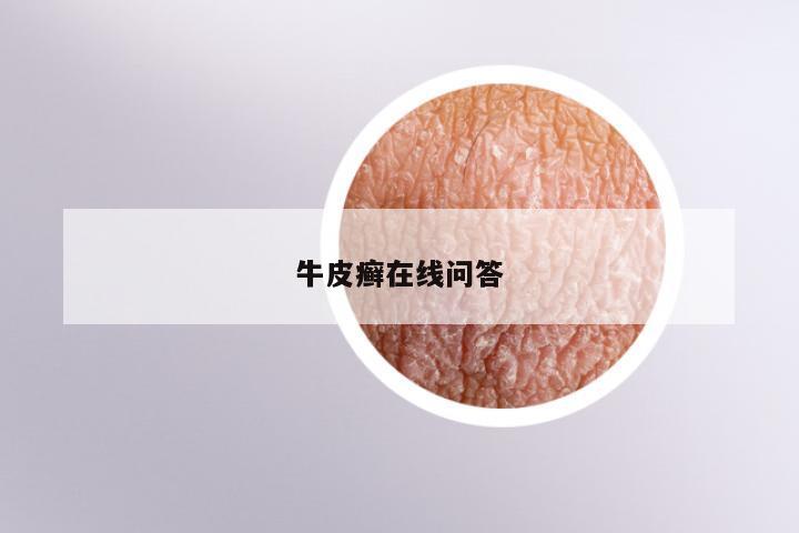 牛皮癣在线问答