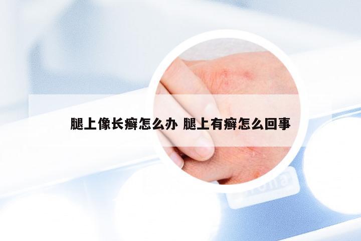 腿上像长癣怎么办 腿上有癣怎么回事
