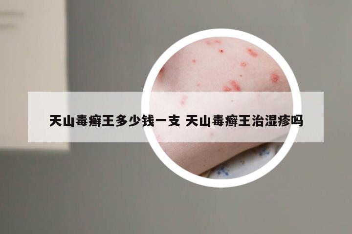 天山毒癣王多少钱一支 天山毒癣王治湿疹吗