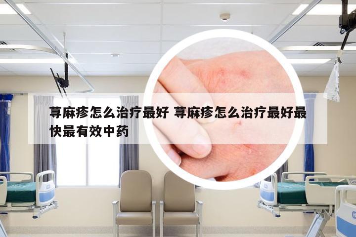 荨麻疹怎么治疗最好 荨麻疹怎么治疗最好最快最有效中药