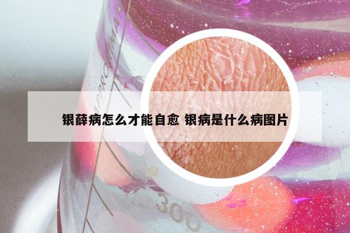 银薛病怎么才能自愈 银病是什么病图片