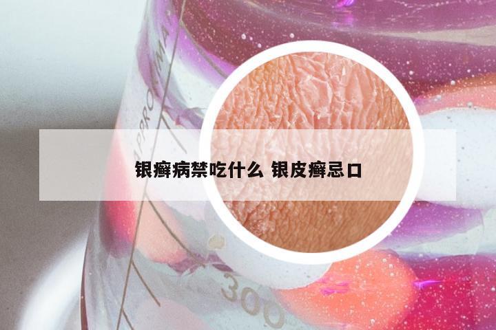 银癣病禁吃什么 银皮癣忌口