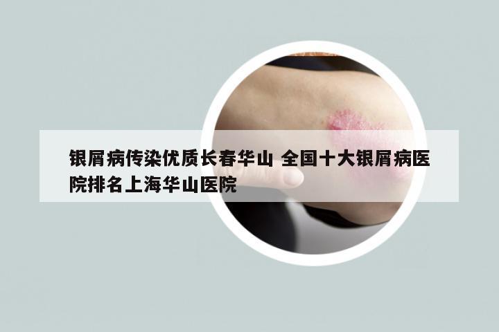 银屑病传染优质长春华山 全国十大银屑病医院排名上海华山医院
