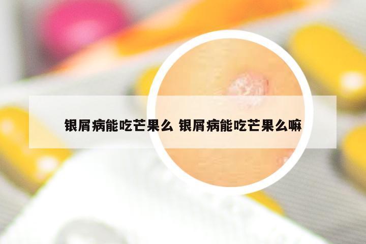 银屑病能吃芒果么 银屑病能吃芒果么嘛