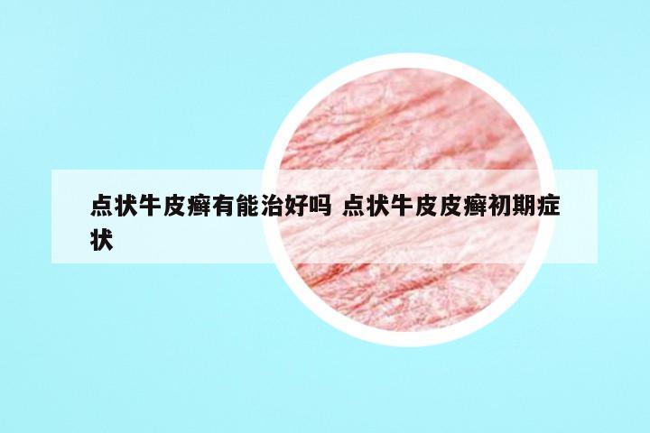 点状牛皮癣有能治好吗 点状牛皮皮癣初期症状