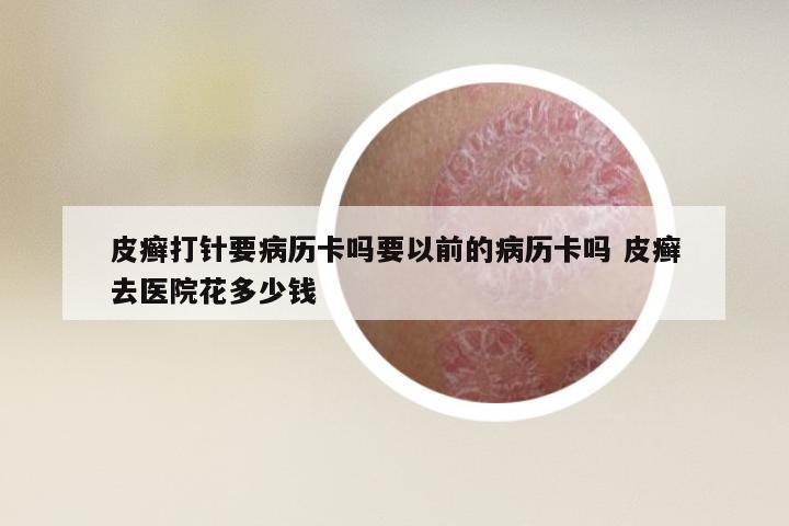 皮癣打针要病历卡吗要以前的病历卡吗 皮癣去医院花多少钱