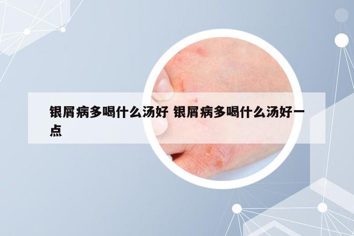 银屑病多喝什么汤好 银屑病多喝什么汤好一点