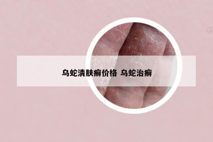 乌蛇清肤癣价格 乌蛇治癣