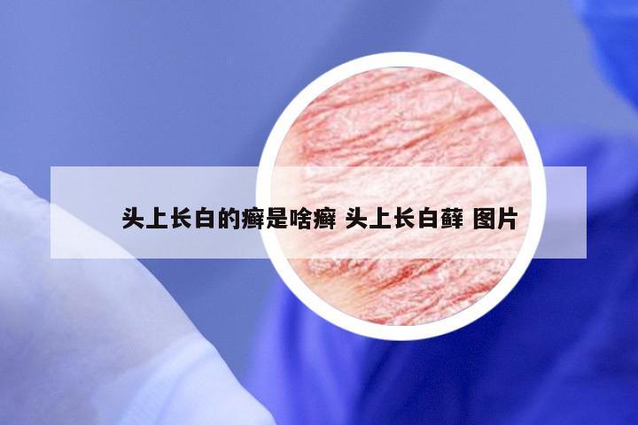 头上长白的癣是啥癣 头上长白藓 图片