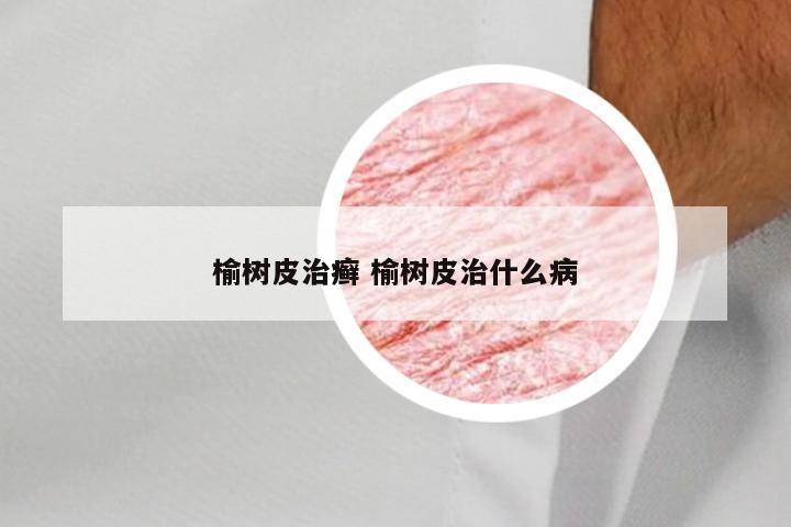 榆树皮治癣 榆树皮治什么病