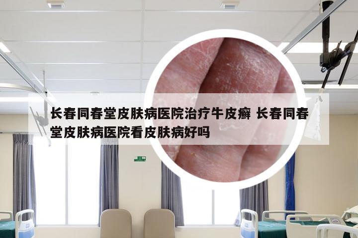 长春同春堂皮肤病医院治疗牛皮癣 长春同春堂皮肤病医院看皮肤病好吗