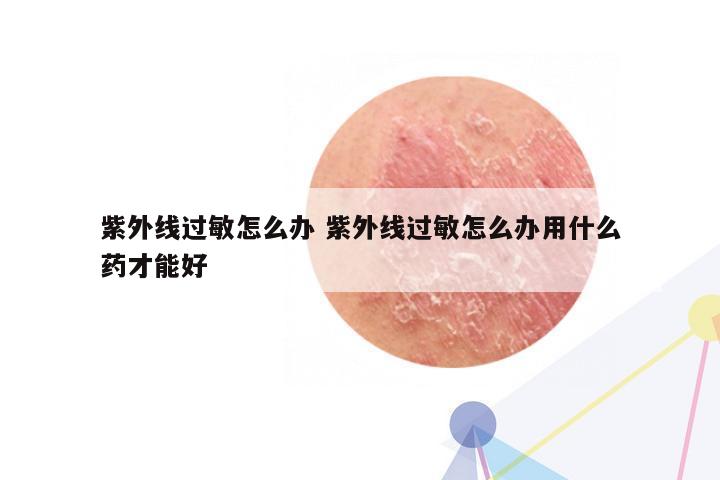 紫外线过敏怎么办 紫外线过敏怎么办用什么药才能好