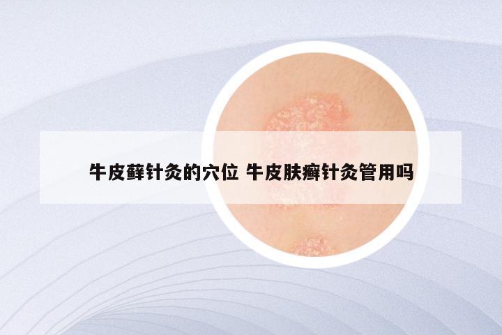 牛皮藓针灸的穴位 牛皮肤癣针灸管用吗