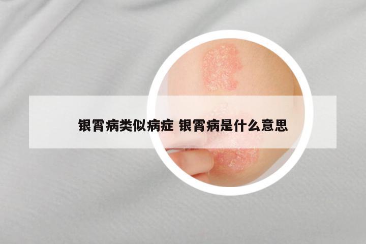 银霄病类似病症 银霄病是什么意思