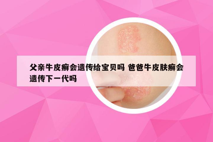 父亲牛皮癣会遗传给宝贝吗 爸爸牛皮肤癣会遗传下一代吗