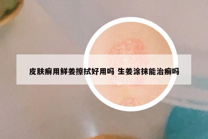 皮肤癣用鲜姜擦拭好用吗 生姜涂抹能治癣吗