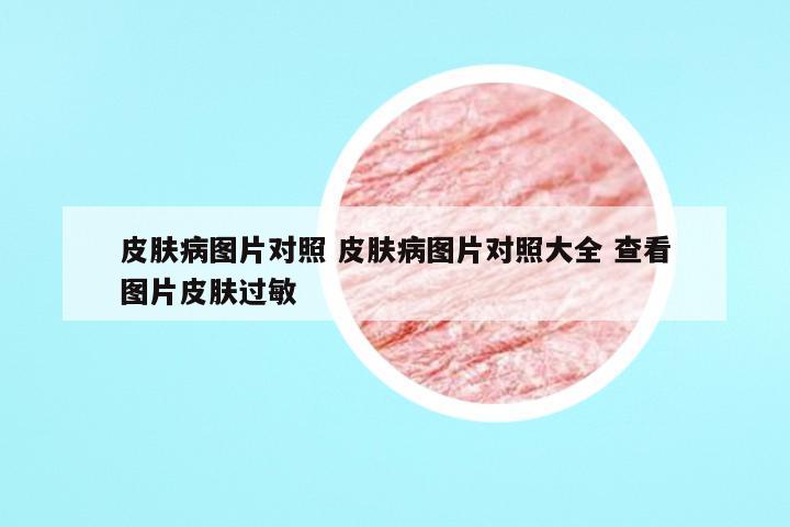 皮肤病图片对照 皮肤病图片对照大全 查看图片皮肤过敏