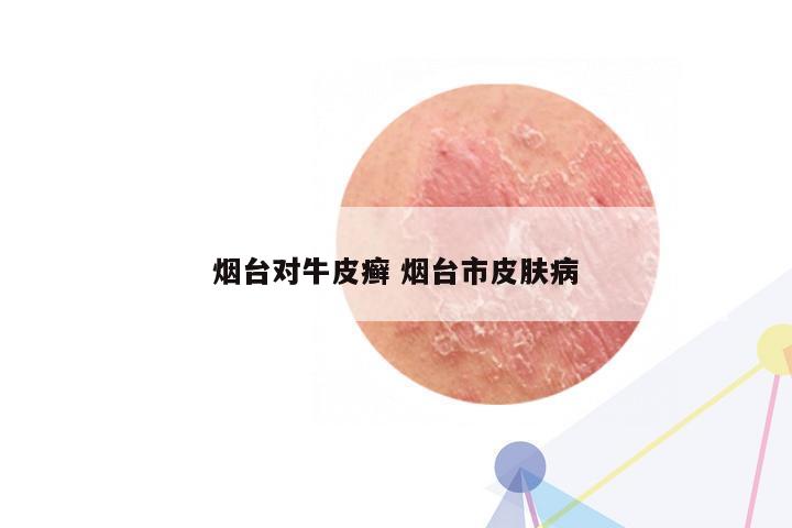 烟台对牛皮癣 烟台市皮肤病