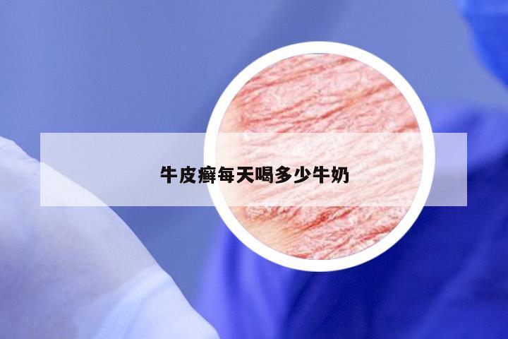 牛皮癣每天喝多少牛奶