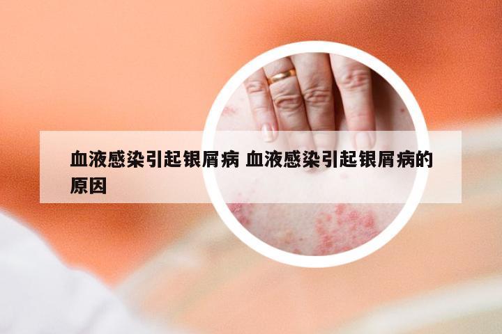 血液感染引起银屑病 血液感染引起银屑病的原因