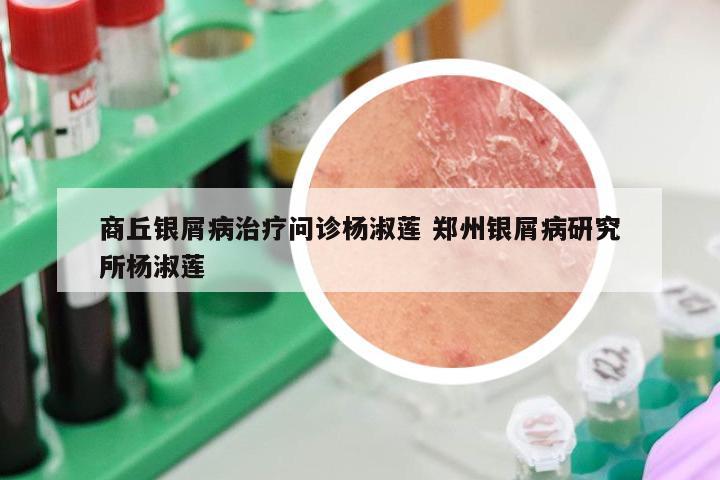 商丘银屑病治疗问诊杨淑莲 郑州银屑病研究所杨淑莲