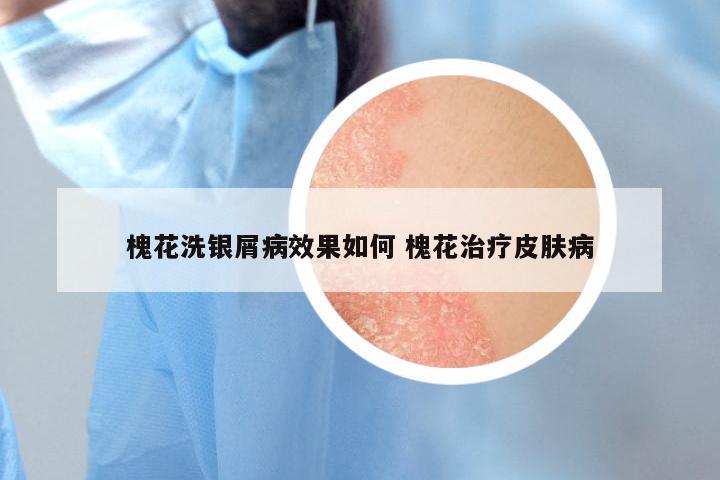 槐花洗银屑病效果如何 槐花治疗皮肤病