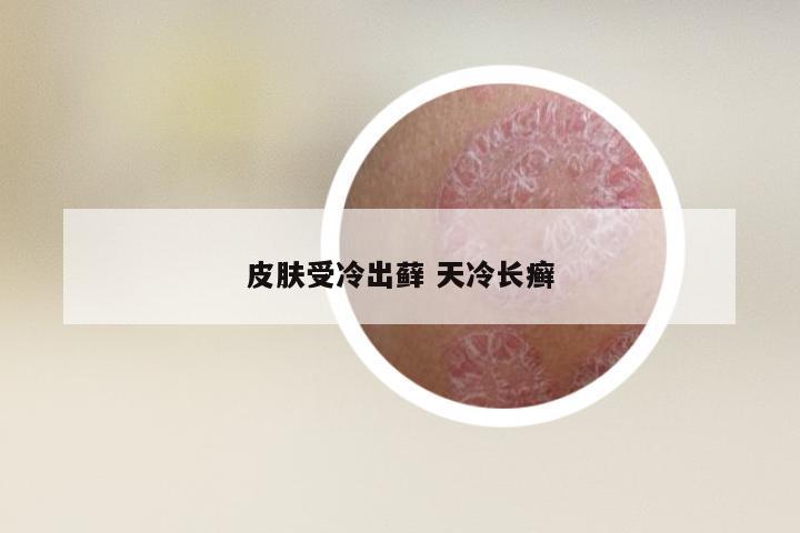 皮肤受冷出藓 天冷长癣