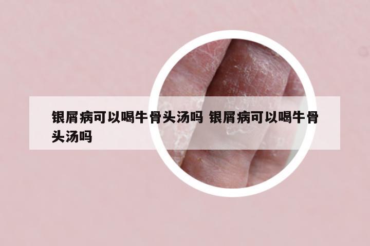 银屑病可以喝牛骨头汤吗 银屑病可以喝牛骨头汤吗