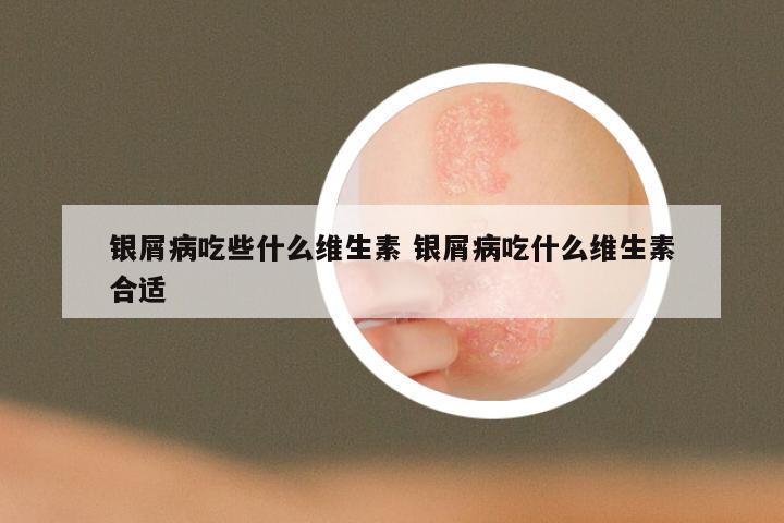 银屑病吃些什么维生素 银屑病吃什么维生素合适