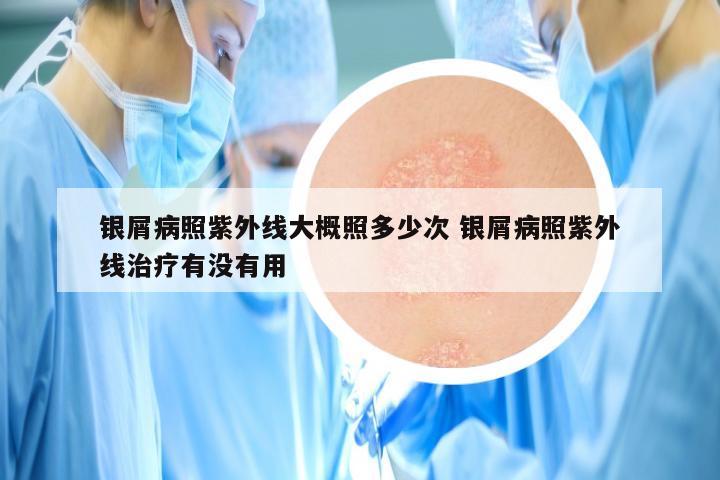 银屑病照紫外线大概照多少次 银屑病照紫外线治疗有没有用