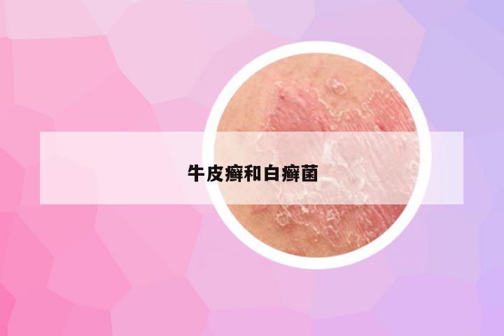 牛皮癣和白癣菌