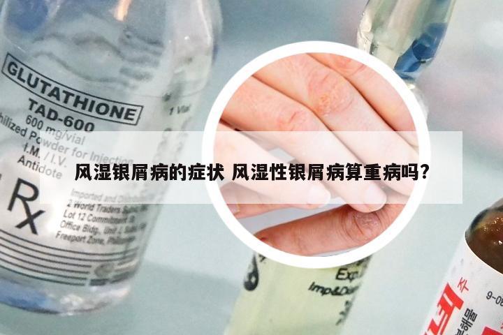 风湿银屑病的症状 风湿性银屑病算重病吗?