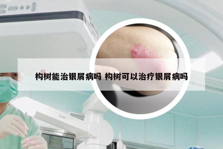 构树能治银屑病吗 构树可以治疗银屑病吗