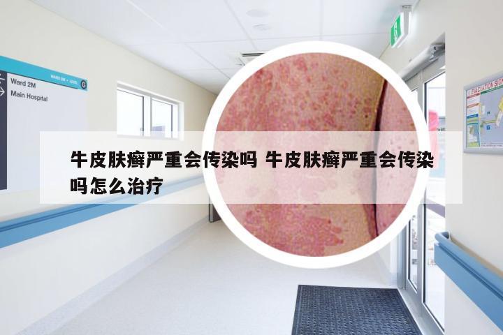 牛皮肤癣严重会传染吗 牛皮肤癣严重会传染吗怎么治疗
