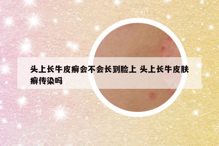 头上长牛皮癣会不会长到脸上 头上长牛皮肤癣传染吗