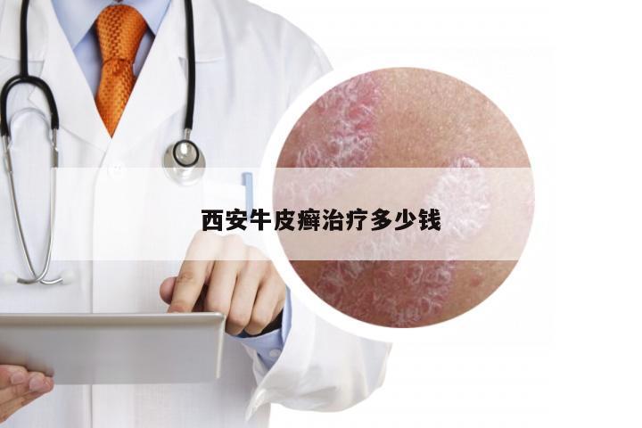 西安牛皮癣治疗多少钱