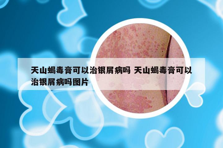天山蝎毒膏可以治银屑病吗 天山蝎毒膏可以治银屑病吗图片