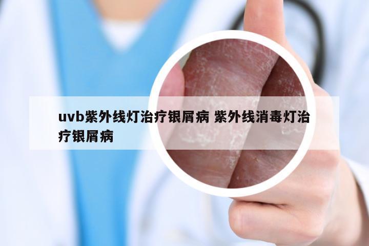 uvb紫外线灯治疗银屑病 紫外线消毒灯治疗银屑病