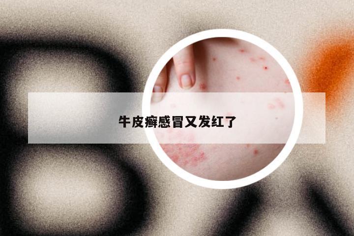 牛皮癣感冒又发红了
