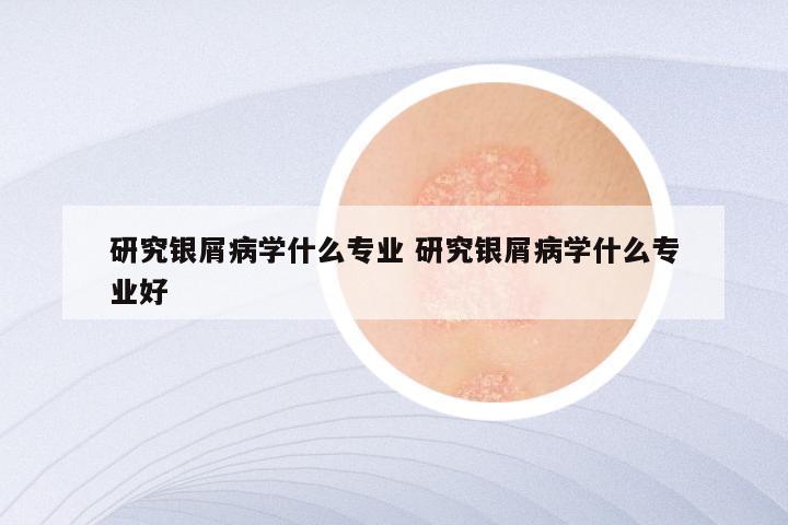 研究银屑病学什么专业 研究银屑病学什么专业好